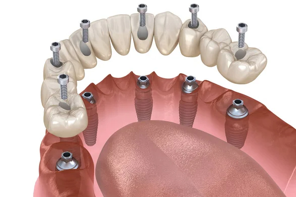 Implant dentar trust clinic tirane albania dental implant
