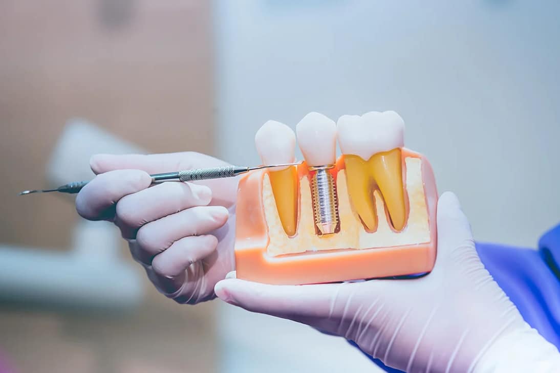 implementim te nje implanti dentar