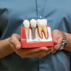 Implant dentar