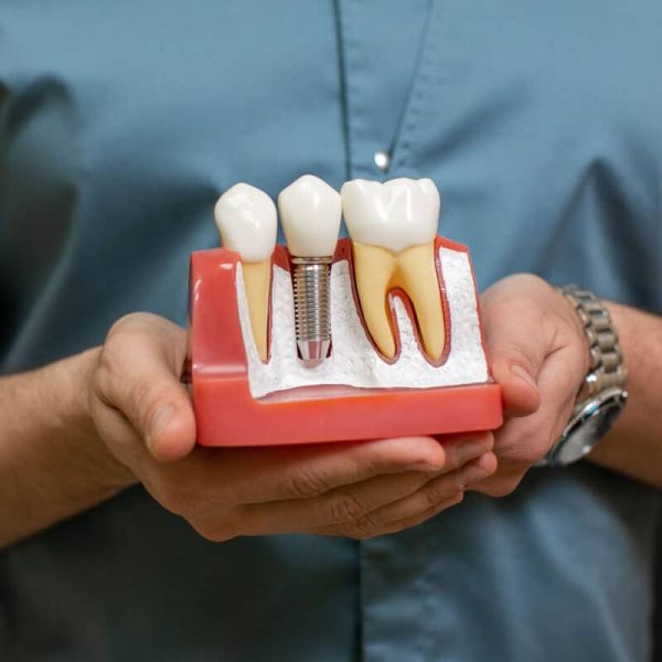 Implant dentar
