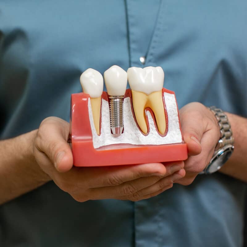Implant dentar